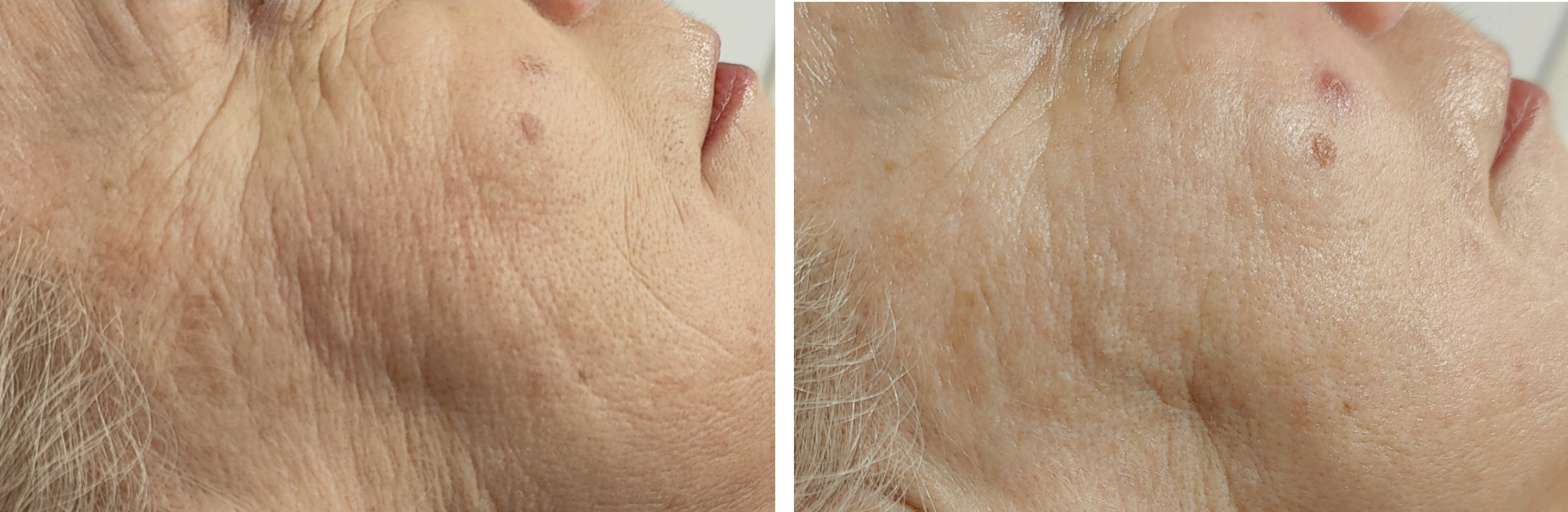 Radiofrekvenssi (RF) Cryo-hoito